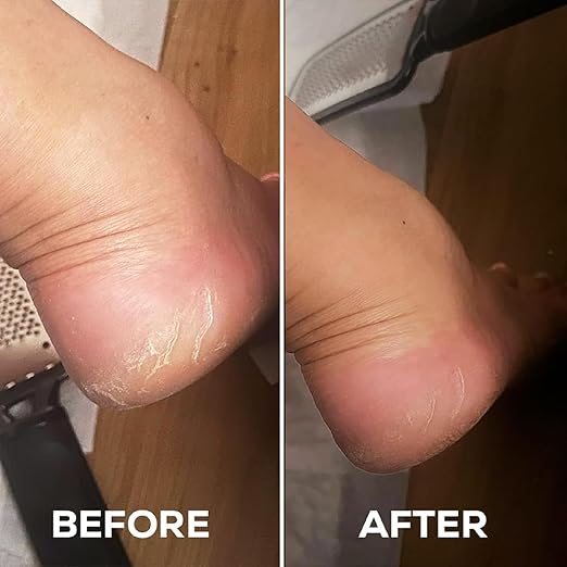 LiveGreater SoftSteps Ritual Set | (Foot exfoliating peel socks)